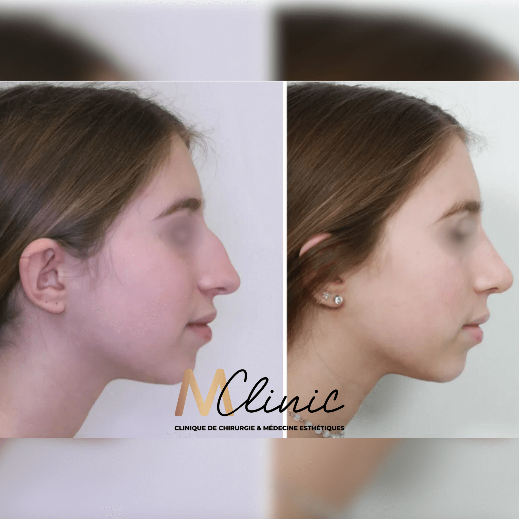 Chirurgie du nez Marrakech Avant Après Cas 1