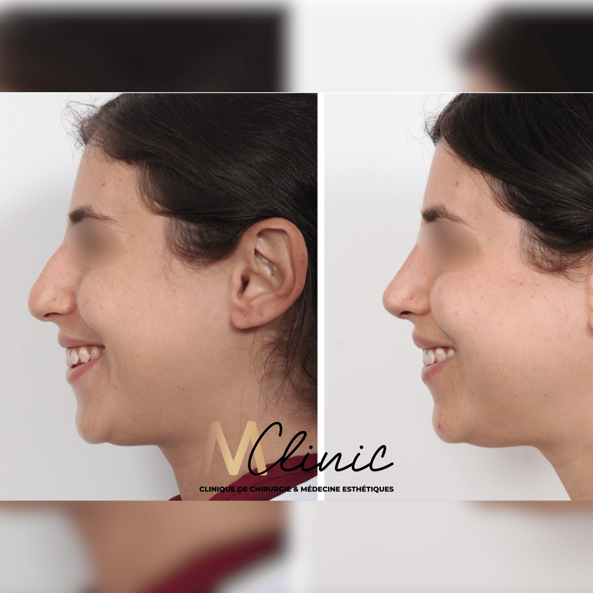 Profiloplastie Maroc Avant Après Cas 2
