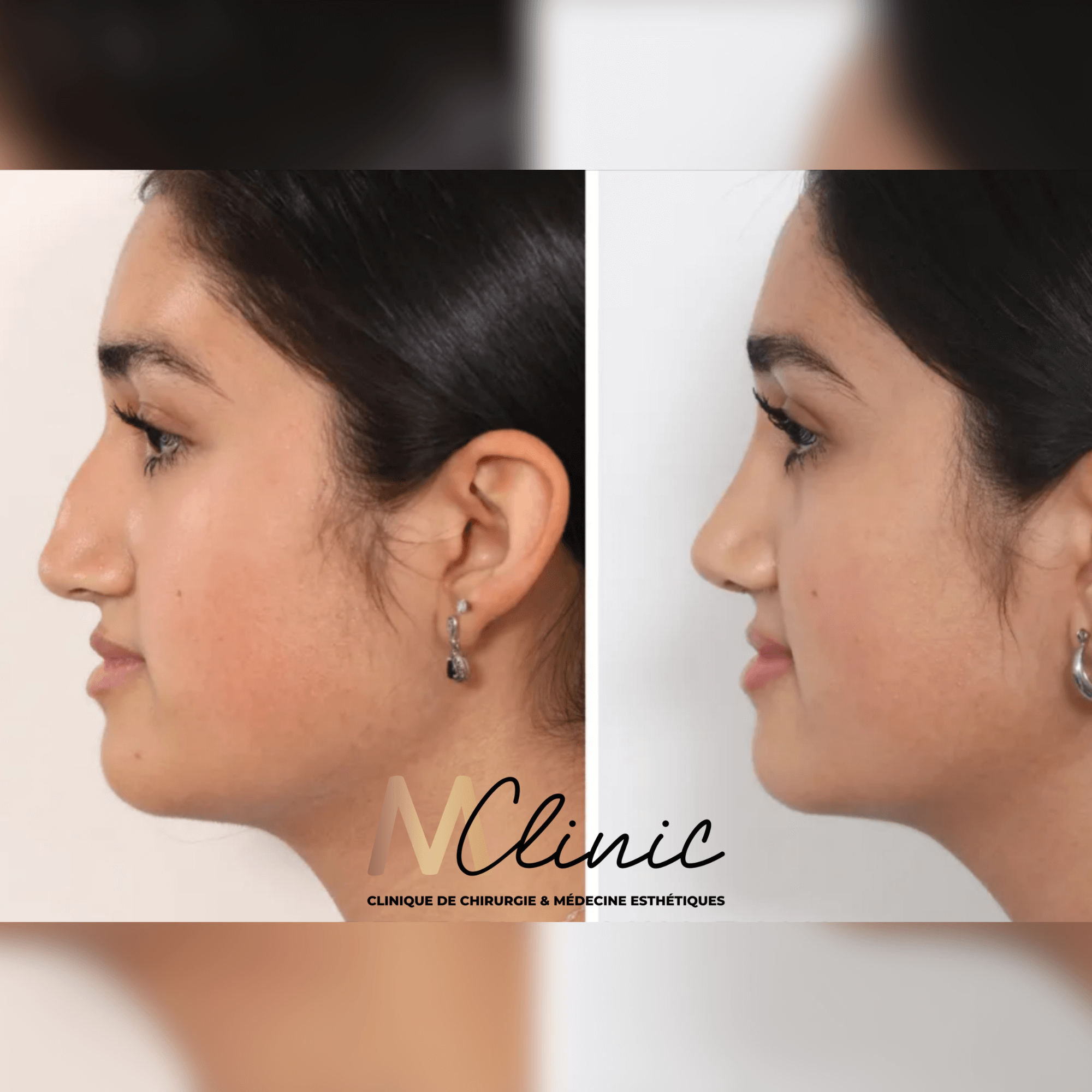Remodelage nez ethnique Avant Après Cas 3